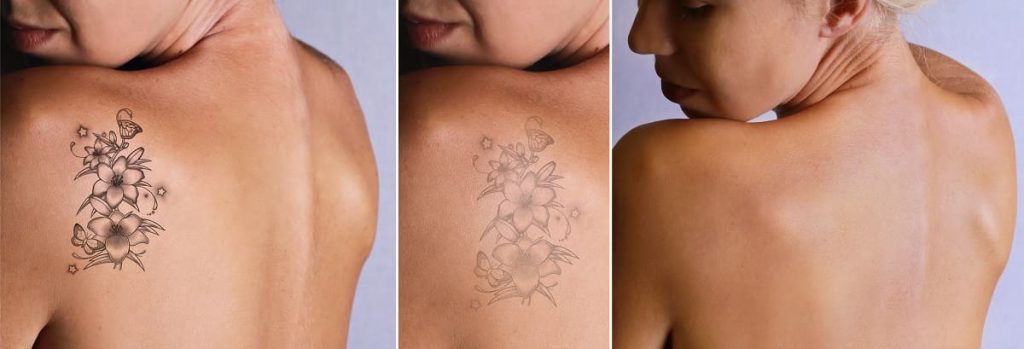 remover-tatuajes-miami