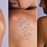 remover-tatuajes-miami
