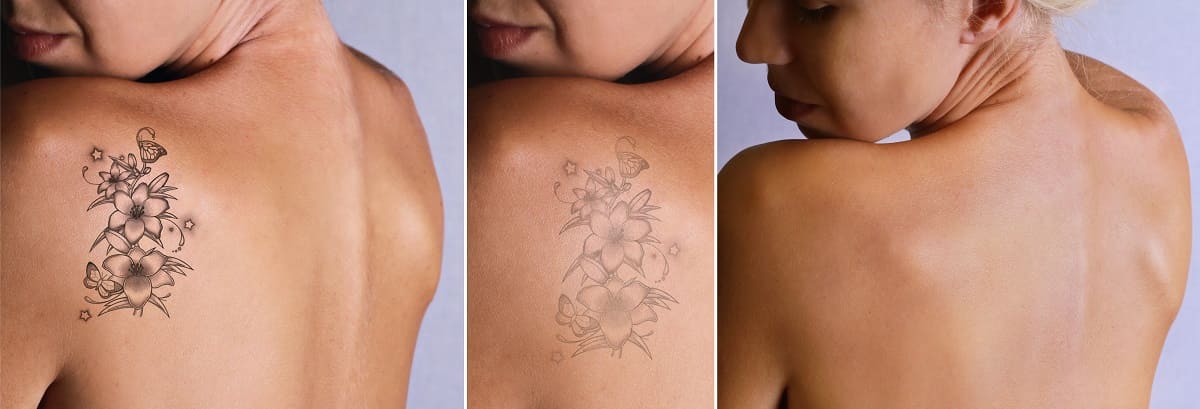 remover-tatuajes-miami